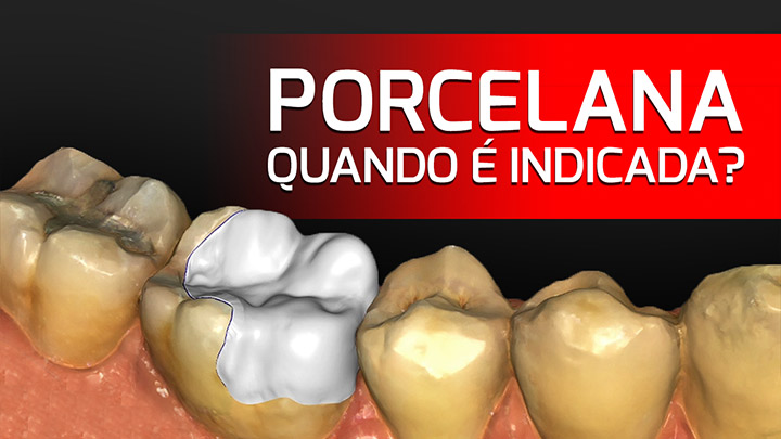 Quando é indicado a Porcelana? Porcelana Odontológica