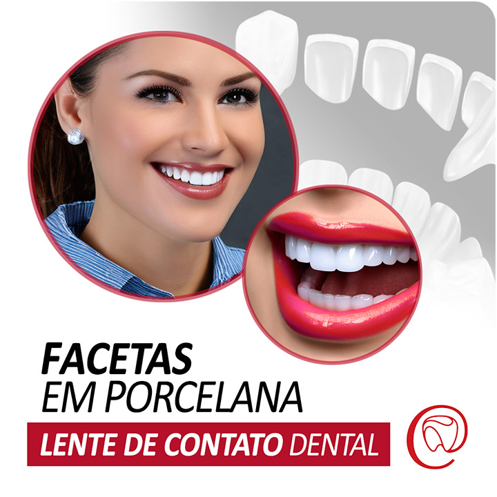 Facetas – Lente de Contato em Porcelana - Restaurar dentes pela coloração, reconstrução e espaçamento